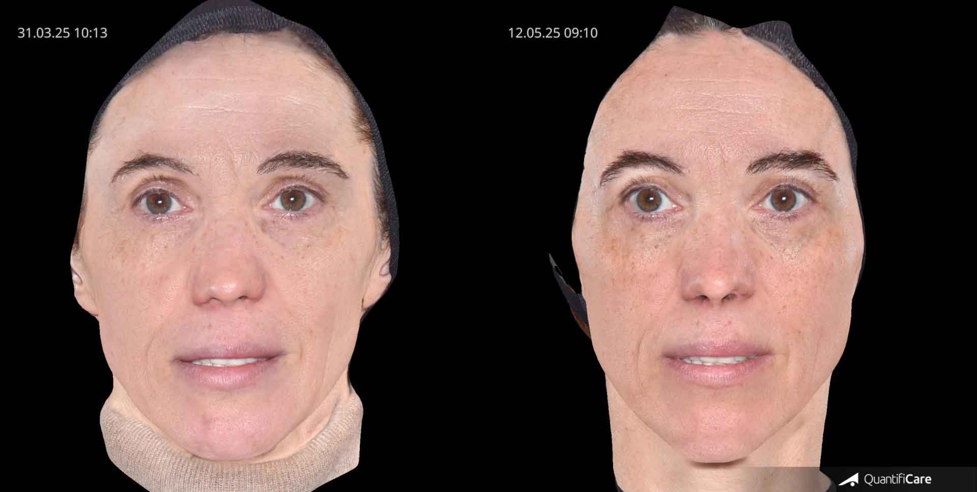 Kollagen Biostimulator Juläine Vorher Nachher in Zürich bei AVORYA