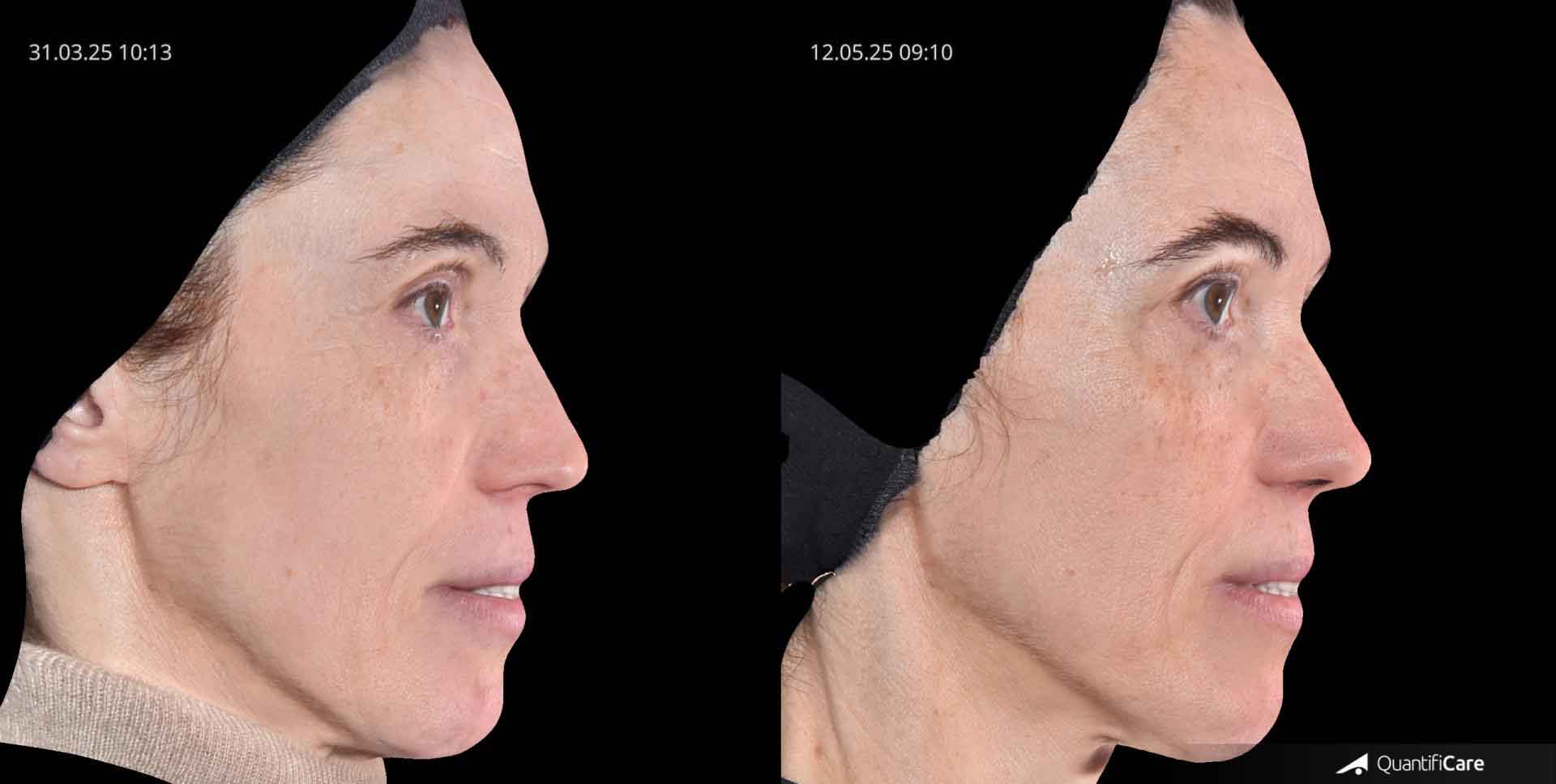 Kollagen Biostimulator Juläine Vorher Nachher in Zürich bei AVORYA