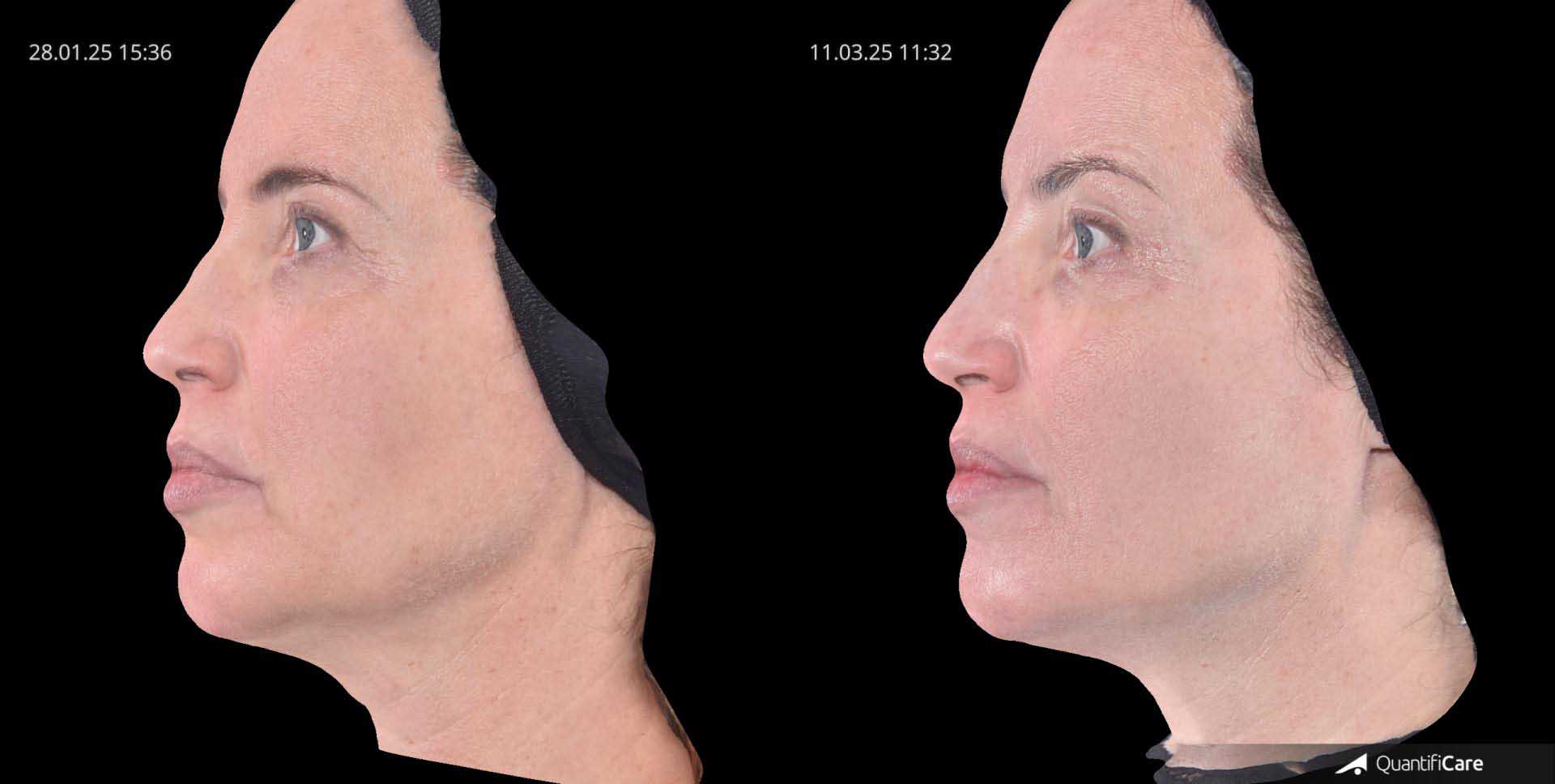 Kollagen Biostimulator Juläine Vorher Nachher in Zürich bei AVORYA