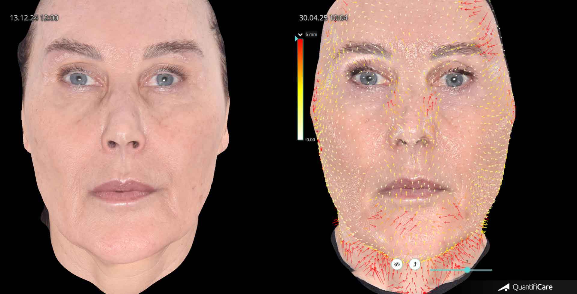 Kollagen Biostimulator Juläine Vorher Nachher in Zürich bei AVORYA