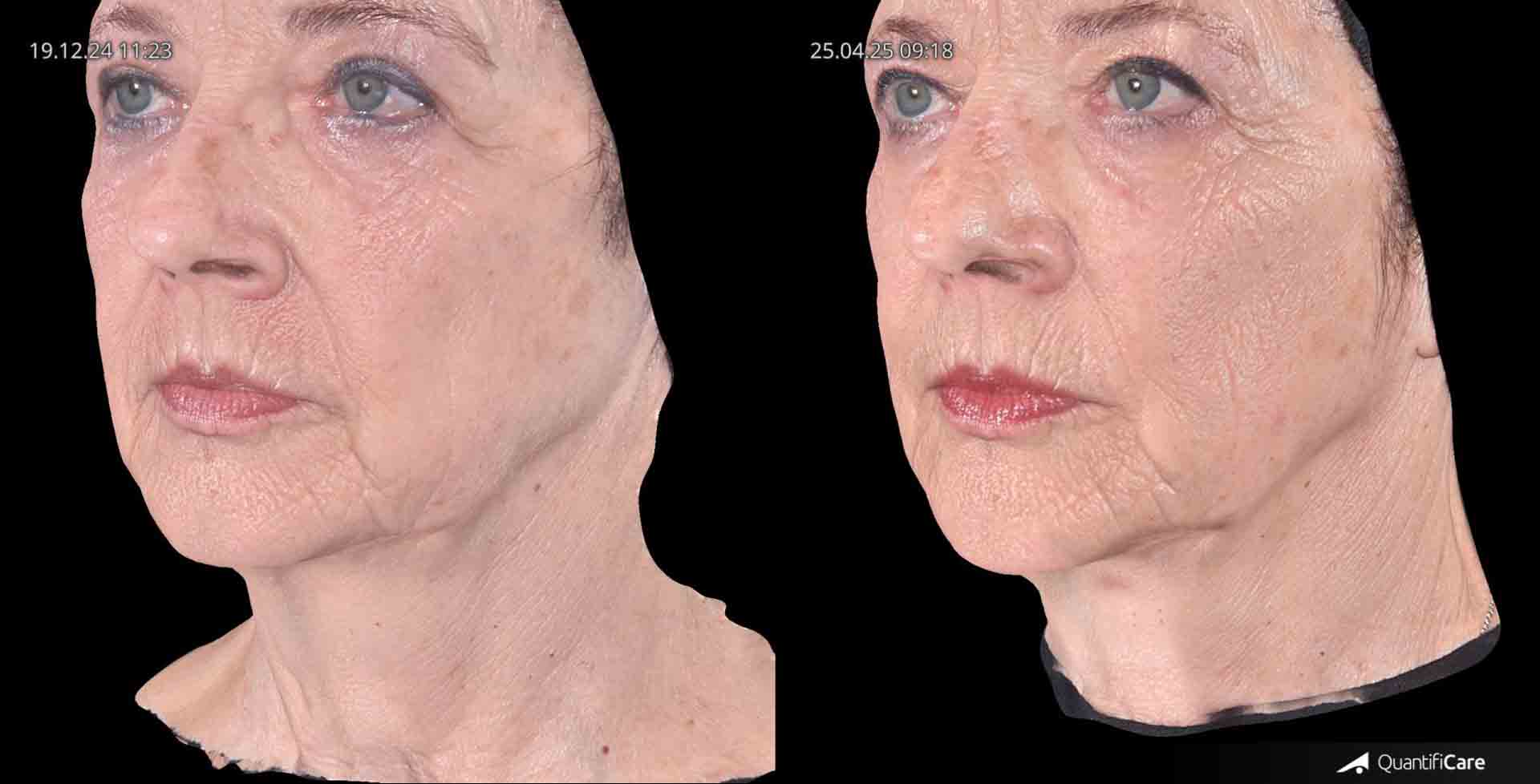 Kollagen Biostimulator Juläine Vorher Nachher in Zürich bei AVORYA