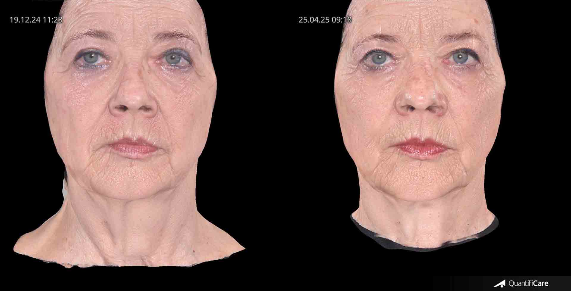 Kollagen Biostimulator Juläine Vorher Nachher in Zürich bei AVORYA