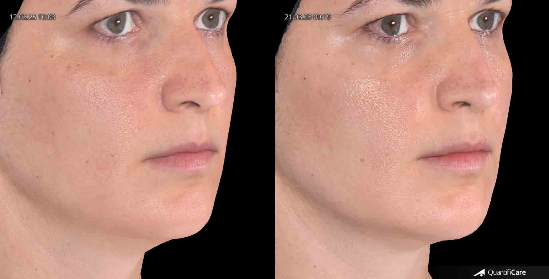 Kollagen Biostimulator Juläine Vorher Nachher in Zürich bei AVORYA